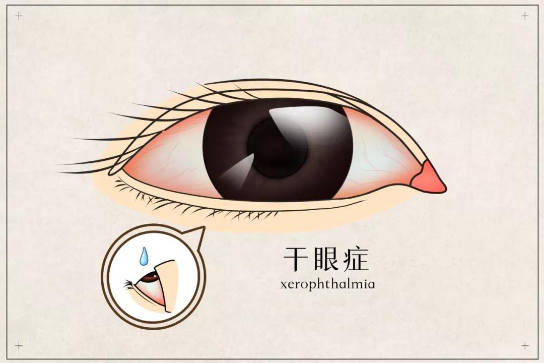 干眼患者福音來(lái)啦！(圖2)